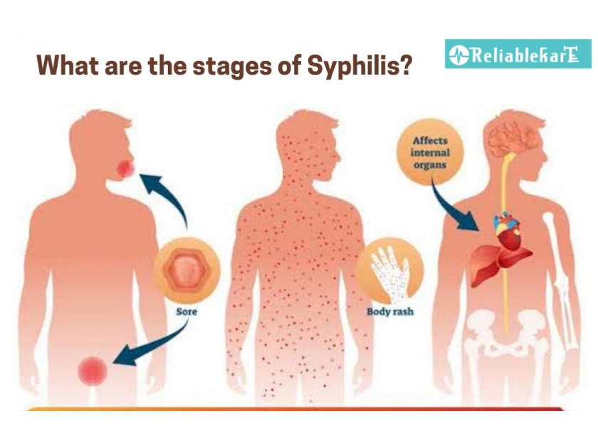presentation of tertiary syphilis